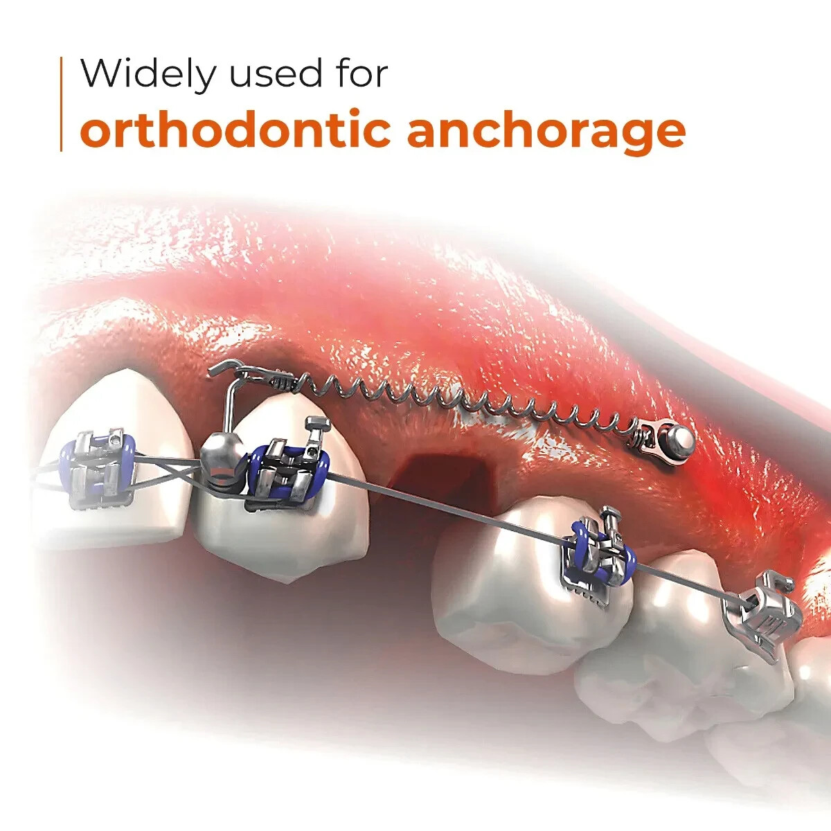 UU Ortho Titanium Mini Implant Free Shipping Worldwide