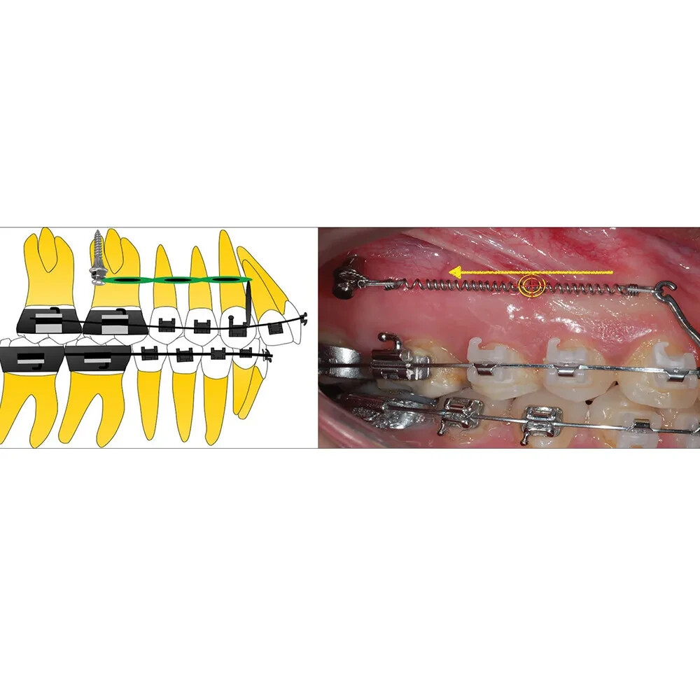UU Ortho Titanium Mini Implant Free Shipping Worldwide