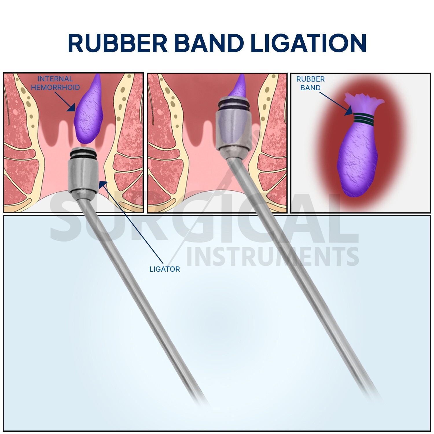 Hemorrhoid Suction Ligator Up Angle With 100 Latex Bands Surgical Instruments