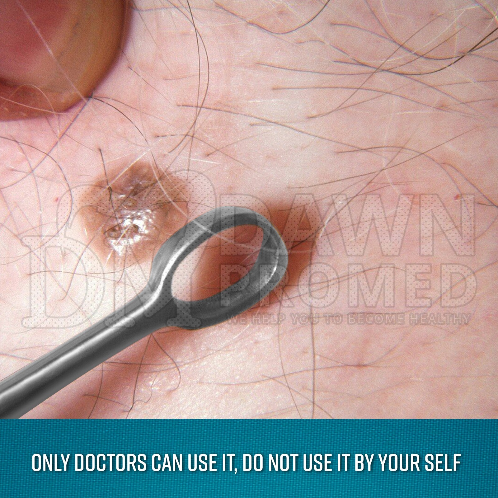 Fox Dermal Curettes Dermatology 1mm – 6mm ENT Instruments German Grade