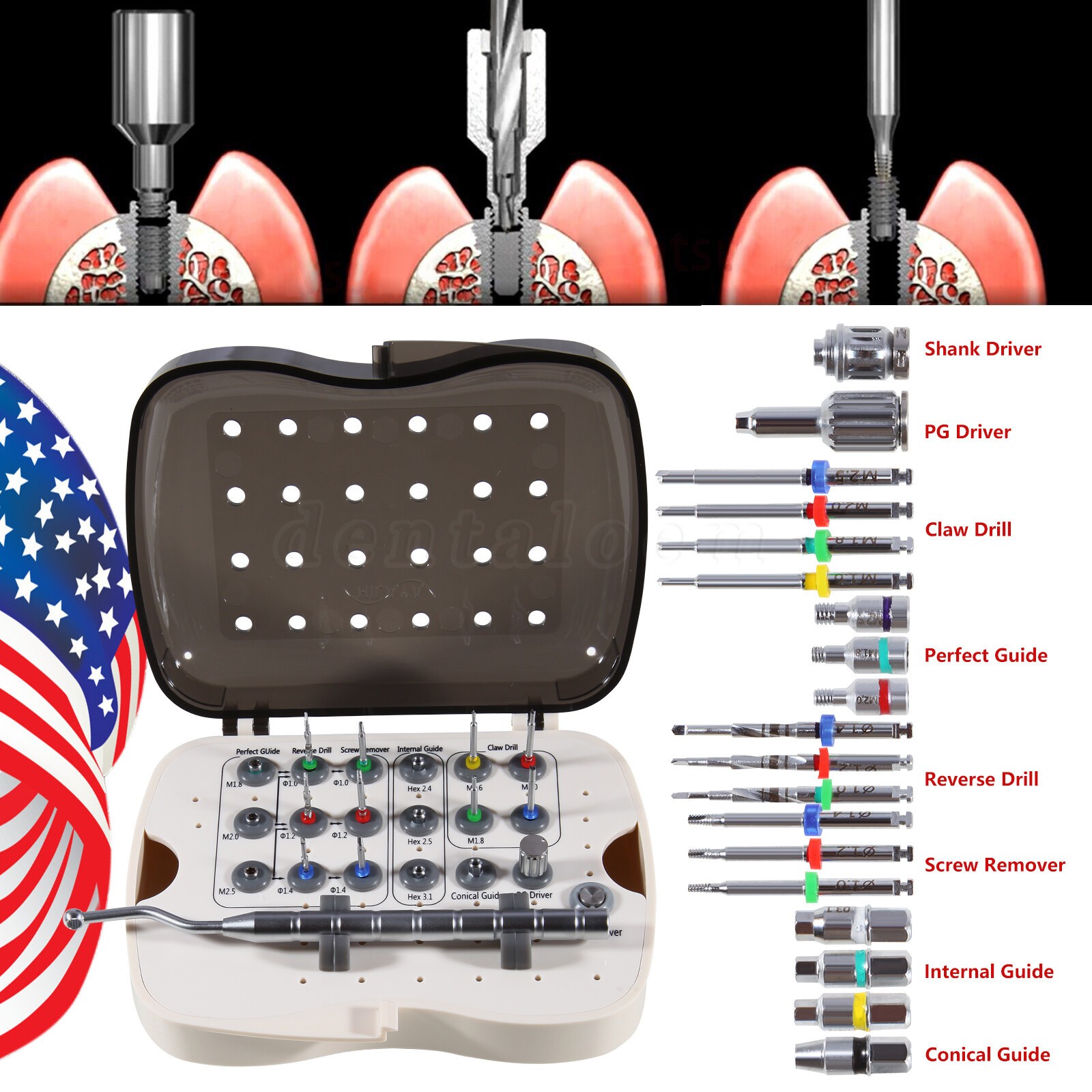 Universal Implant Fractured Broken Screw Removal Kit Surgical Remover NeoBiotech